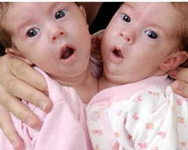 异于常人连体人